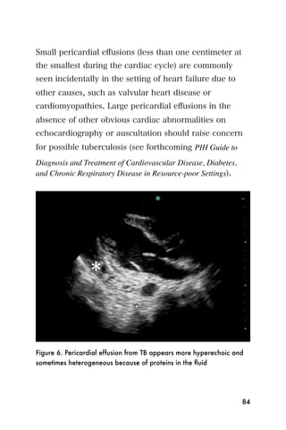 Small pericardial eﬀusions (less than one centimeter at
the smallest during the cardiac cycle) are commonly
seen incidentally in the setting of heart failure due to
other causes, such as valvular heart disease or
cardiomyopathies. Large pericardial eﬀusions in the
absence of other obvious cardiac abnormalities on
echocardiography or auscultation should raise concern
for possible tuberculosis (see forthcoming PIH Guide to
Diagnosis and Treatment of Cardiovascular Disease, Diabetes,
and Chronic Respiratory Disease in Resource-poor Settings).




Figure 6. Pericardial effusion from TB appears more hyperechoic and
sometimes heterogeneous because of proteins in the ﬂuid




                                                                  84
 