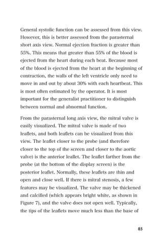 General systolic function can be assessed from this view.
However, this is better assessed from the parasternal
short axis view. Normal ejection fraction is greater than
55%. This means that greater than 55% of the blood is
ejected from the heart during each beat. Because most
of the blood is ejected from the heart at the beginning of
contraction, the walls of the left ventricle only need to
move in and out by about 30% with each heartbeat. This
is most often estimated by the operator. It is most
important for the generalist practitioner to distinguish
between normal and abnormal function.

From the parasternal long axis view, the mitral valve is
easily visualized. The mitral valve is made of two
leaﬂets, and both leaﬂets can be visualized from this
view. The leaﬂet closer to the probe (and therefore
closer to the top of the screen and closer to the aortic
valve) is the anterior leaﬂet. The leaﬂet farther from the
probe (at the bottom of the display screen) is the
posterior leaﬂet. Normally, these leaﬂets are thin and
open and close well. If there is mitral stenosis, a few
features may be visualized. The valve may be thickened
and calciﬁed (which appears bright white, as shown in
Figure 7), and the valve does not open well. Typically,
the tips of the leaﬂets move much less than the base of


                                                            85
 
