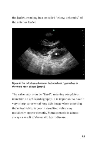 the leaﬂet, resulting in a so-called elbow deformity of
the anterior leaﬂet.




Figure 7. The mitral valve becomes thickened and hyperechoic in
rheumatic heart disease (arrow)


The valve may even be ﬁxed , meaning completely
immobile on echocardiography. It is important to have a
very sharp parasternal long axis image when assessing
the mitral valve. A poorly visualized valve may
mistakenly appear stenotic. Mitral stenosis is almost
always a result of rheumatic heart disease.




                                                                  86
 