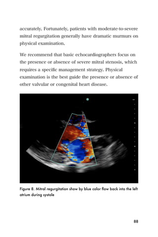accurately. Fortunately, patients with moderate-to-severe
mitral regurgitation generally have dramatic murmurs on
physical examination.

We recommend that basic echocardiographers focus on
the presence or absence of severe mitral stenosis, which
requires a speciﬁc management strategy. Physical
examination is the best guide the presence or absence of
other valvular or congenital heart disease.




Figure 8. Mitral regurgitation show by blue color ﬂow back into the left
atrium during systole




                                                                     88
 