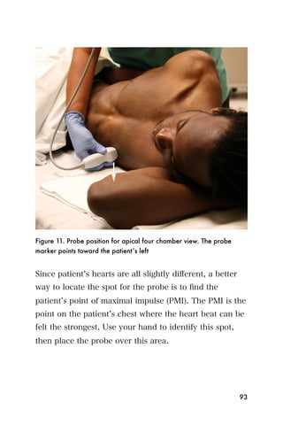 Figure 11. Probe position for apical four chamber view. The probe
marker points toward the patient’s left


Since patient s hearts are all slightly diﬀerent, a better
way to locate the spot for the probe is to ﬁnd the
patient s point of maximal impulse (PMI). The PMI is the
point on the patient s chest where the heart beat can be
felt the strongest. Use your hand to identify this spot,
then place the probe over this area.




                                                                    93
 