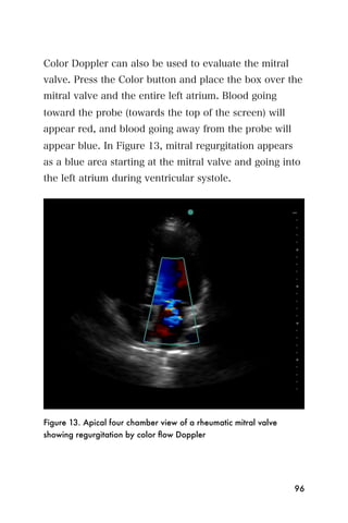 Color Doppler can also be used to evaluate the mitral
valve. Press the Color button and place the box over the
mitral valve and the entire left atrium. Blood going
toward the probe (towards the top of the screen) will
appear red, and blood going away from the probe will
appear blue. In Figure 13, mitral regurgitation appears
as a blue area starting at the mitral valve and going into
the left atrium during ventricular systole.




Figure 13. Apical four chamber view of a rheumatic mitral valve
showing regurgitation by color ﬂow Doppler




                                                                  96
 