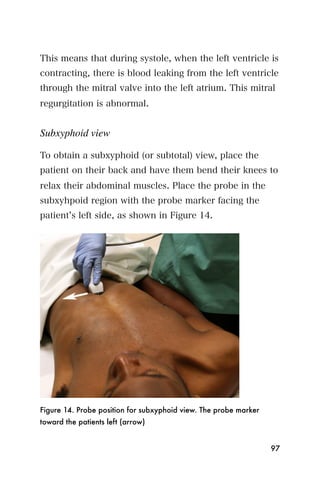 This means that during systole, when the left ventricle is
contracting, there is blood leaking from the left ventricle
through the mitral valve into the left atrium. This mitral
regurgitation is abnormal.


Subxyphoid view

To obtain a subxyphoid (or subtotal) view, place the
patient on their back and have them bend their knees to
relax their abdominal muscles. Place the probe in the
subxyhpoid region with the probe marker facing the
patient s left side, as shown in Figure 14.




Figure 14. Probe position for subxyphoid view. The probe marker
toward the patients left (arrow)


                                                                  97
 