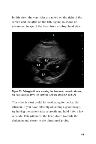 In this view, the ventricles are noted on the right of the
screen and the atria on the left. Figure 15 shows an
ultrasound image of the heart from a subxyphoid view.




Figure 15. Subxyphoid view showing the liver as an acoustic window,
the right ventricle (RV), left ventricle (LV) and atria (RA and LA)


This view is most useful for evaluating for pericardial
eﬀusion. If you have diﬃculty obtaining a good image,
try having the patient take a breath and hold it for a few
seconds. This will move the heart down towards the
abdomen and closer to the ultrasound probe.




                                                                      98
 