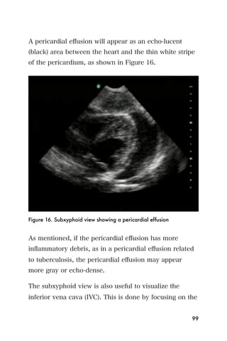A pericardial eﬀusion will appear as an echo-lucent
(black) area between the heart and the thin white stripe
of the pericardium, as shown in Figure 16.




Figure 16. Subxyphoid view showing a pericardial effusion


As mentioned, if the pericardial eﬀusion has more
inﬂammatory debris, as in a pericardial eﬀusion related
to tuberculosis, the pericardial eﬀusion may appear
more gray or echo-dense.

The subxyphoid view is also useful to visualize the
inferior vena cava (IVC). This is done by focusing on the


                                                            99
 