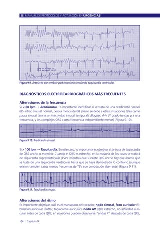 MANUAL DE PROTOCOLOS Y ACTUACIÓN EN URGENCIAS
104 l Capítulo 9
Figura 9.9. Artefacto por temblor parkinsoniano simulando taquicardia ventricular.
DIAGNÓSTICOS ELECTROCARDIOGRÁFICOS MÁS FRECUENTES
Alteraciones de la frecuencia
Si < 60 lpm Æ Bradicardia. Es importante identificar si se trata de una bradicardia sinusal
(BS: ritmo sinusal normal, pero a menos de 60 lpm) o se debe a otras situaciones tales como
pausa sinusal (existe un inactividad sinusal temporal), Bloqueo A-V 3º grado (ondas p a una
frecuencia, y los complejos QRS a otra frecuencia independiente menor) (Figura 9.10).
Si > 100 lpm Æ Taquicardia. En este caso, lo importante es objetivar si se trata de taquicardia
de QRS ancho o estrecho. Cuando el QRS es estrecho, en la mayoría de los casos se tratará
de taquicardia supraventricular (TSV), mientras que si existe QRS ancho hay que asumir que
se trata de una taquicardia ventricular hasta que se haya demostrado lo contrario (aunque
existen también casos menos frecuentes de TSV con conducción aberrante) (Figura 9.11).
Alteraciones del ritmo
Es importante objetivar cuál es el marcapaso del corazón: nodo sinusal, foco auricular (fi-
brilación auricular, flutter, taquicardia auricular), nodo AV (QRS estrecho, no actividad auri-
cular antes de cada QRS; en ocasiones pueden observarse “ondas P” después de cada QRS,
Figura 9.10. Bradicardia sinusal.
Figura 9.11. Taquicardia sinusal.
 