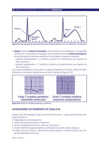 • Onda T: existen cambios funcionales, más frecuentes en la adolescencia, considerados
variantes de la normalidad. Sin embargo, más frecuentemente son cambios patológicos,
siendo de especial importancia identificar los secundarios a isquemia miocárdica:
– Isquemia subendocárdica Æ T simétrica y picuda en las derivaciones que registrán las
áreas isquémicas.
– Isquemia subepicárdica Æ T invertida y simétrica en las derivaciones que registran las
áreas isquémicas.
Los cambios patólogicos no secundarios a isquemia (hipertrofia ventricular, trastornos hidro-
electrolíticos, etc) suelen representarse con onda T asimétrica (Figura 9.14).
ALTERACIONES DE SEGMENTO QT (Tabla 9.4)
Pueden verse QTc alargados (riesgo de arritmias ventriculares Æ taquicardia ventricular (Tor-
sade de Points) en:
• Hipopotasemia, hipomagnesemia.
• Antiarrítmicos (procainamida, amiodarona).
• ACVA, antidepresivos tricíclicos, astemizol, eritromicina.
• Síndrome del QT alargado congénito (anomalía de los canales iónicos cardiacos).
• Pueden verse QTc cortos en: hipercalcemia, efecto digitálico, síndrome del QT corto con-
génito (extremadamente raro).
MANUAL DE PROTOCOLOS Y ACTUACIÓN EN URGENCIAS
108 l Capítulo 9
Figura 9.13. Dos ejemplos de repolarización precoz (Tomado de Pérez et al. Am J Med 2011, con permiso).
Figura 9.14. Ondas T invertidas asimétricas y simétricas.
 