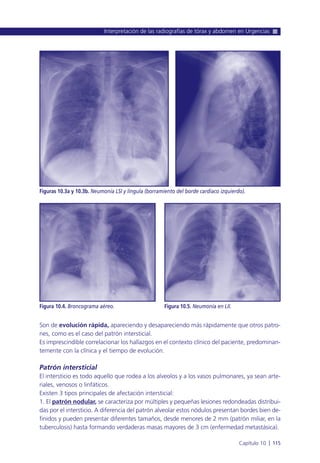 Son de evolución rápida, apareciendo y desapareciendo más rápidamente que otros patro-
nes, como es el caso del patrón intersticial.
Es imprescindible correlacionar los hallazgos en el contexto clínico del paciente, predominan-
temente con la clínica y el tiempo de evolución.
Patrón intersticial
El intersticio es todo aquello que rodea a los alveolos y a los vasos pulmonares, ya sean arte-
riales, venosos o linfáticos.
Existen 3 tipos principales de afectación intersticial:
1. El patrón nodular, se caracteriza por múltiples y pequeñas lesiones redondeadas distribui-
das por el intersticio. A diferencia del patrón alveolar estos nódulos presentan bordes bien de-
finidos y pueden presentar diferentes tamaños, desde menores de 2 mm (patrón miliar, en la
tuberculosis) hasta formando verdaderas masas mayores de 3 cm (enfermedad metastásica).
Interpretación de las radiografías de tórax y abdomen en Urgencias
Capítulo 10 l 115
Figuras 10.3a y 10.3b. Neumonía LSI y língula (borramiento del borde cardiaco izquierdo).
Figura 10.4. Broncograma aéreo. Figura 10.5. Neumonía en LII.
 