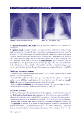 2. El patrón reticulonodular o mixto, típico de la silicosis, la sarcoidosis o la linfangitis car-
cinomatosa.
3. El patrón lineal, que se produce por un engrosamiento del tejido intersticial que rodea a
los bronquios y a los vasos, dando lugar a opacidades lineales y paralelas como las líneas A y
B de Kerley en el edema pulmonar intersticial. Las líneas A se extienden desde el parénquima
pulmonar hacia el hilio, mientras que las líneas B son más cortas, contactando con la superficie
pleural adyacente. Este patrón también aparece en las neumonías virales o bacterianas atípi-
cas. Dentro del patrón lineal se encuentra el patrón reticular, que se caracteriza por una
afectación difusa con aparición de una red de líneas que dejan entre ellas unas cavidades lu-
centes. Este patrón es el asociado a las enfermedades destructivas del parénquima pulmonar,
con formación de áreas quísticas (Ejemplo: fibrosis pulmonar idiopática) (Figuras 10.6 y 10.7).
Nódulos y masas pulmonares
La diferencia entre nódulo y masa pulmonar radica en su tamaño, siendo el nódulo menor
de 3 cm y la masa mayor de 3 cm.
Hay características radiológicas del nódulo que nos pueden orientar a definir su naturaleza:
ciertos tipos de calcificaciones (nido central, laminar o en palomita de maíz) y una estabi-
lidad de 2 años respecto a radiologías previas indican benignidad.
Pueden ser únicos o múltiples, siendo la primera patología a descartar un cáncer de pulmón
o una afectación metastásica respectivamente (Figuras 10.8 y 10.9).
Cavidades y quistes
El enfisema, los quistes, bullas, bronquiectasias etc. son espacios aéreos anormales que asocian
una destrucción del parénquima pulmonar y que se desarrollan en una gran variedad de en-
tidades: enfermedad obstructiva crónica (EPOC), traumatismos, infecciones, fibrosis pulmonar,etc.
Generalmente presentan unas paredes finas (menor de 3 mm), unos bordes bien definidos y un
contenido aéreo, aunque pueden presentar líquido en su interior en episodios de sobreinfección.
Una cavitación, sin embargo, es un espacio ocupado por gas en el seno de una consolidación, nó-
dulo o masa pulmonar. Se produce como consecuencia a una necrosis intralesional y a la expulsión
de parte de su contenido al árbol bronquial (ejemplo: absceso pulmonar) (Figuras 10.10 y 10.11).
MANUAL DE PROTOCOLOS Y ACTUACIÓN EN URGENCIAS
116 l Capítulo 10
Figura 10.6. Infiltrado intersticial (EAP). Figura 10.7. Patrón miliar (TBC).
 