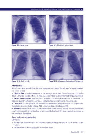 Atelectasia
Se define como la pérdida de volumen o expansión incompleta del pulmón. Se puede producir
por varias causas:
1. Obstructiva: por obstrucción de la vía aérea ya sea a nivel de un bronquio principal o
distal. Ejemplos: cuerpo extraño (niños), tapón de moco, carcinoma endobronquial (adultos).
2. Pasiva o compresiva: por lesiones o procesos ocupantes de espacio en el tórax que co-
lapsan el pulmón adyacente, como por ejemplo el derrame pleural o el neumotórax.
3. Cicatricial: por incapacidad del pulmón para expandirse adecuadamente por procesos in-
flamatorios crónicos (tuberculosis –TBC–, neumonitis post-radiación, FPI).
4. Adhesiva: es la que se asocia a una alteración del surfactante pulmonar (distrés respiratorio
en el recién nacido), presentándose una incapacidad del pulmón para expandirse aunque la
vía aérea esté permeable.
Signos de las atelectasias
Directos:
• Aumento de densidad del pulmón atelectasiado (radiopaco) y agrupación de los bronquios
y vasos.
• Desplazamiento de las cisuras (el más importante).
Interpretación de las radiografías de tórax y abdomen en Urgencias
Capítulo 10 l 117
Figura 10.8. Hamartoma. Figura 10.9. Metástasis pulmonares.
Figura 10.10. Bulla en LSD. Figura 10.11. Bulla sobreinfectada (nivel hidroaéreo).
 