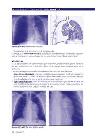 • Desplazamiento de las estructuras de la línea media.
Cuando hay un hidroneumotórax se observa un nivel hidroaéreo en el interior de la cavidad
pleural. Puede ser por sobreinfección del derrame, fístula broncopleural o iatrogénico.
Mediastino
Es un espacio delimitado anteriormente por el esternón, posteriormente por las vértebras
dorsales, lateralmente por la superficie pleural de ambos pulmones e inferiormente por el
diafragma.
En cuanto a la semiología mediastínica debemos destacar una serie de signos:
• Signo de la embarazada: una masa mediastínica, como cualquier otra lesión extraparen-
quimatosa, presenta bordes bien definidos y lisos formando ángulos obtusos con la super-
ficie pleural adyacente, con un borde convexo hacia el pulmón.
• Signo del hilio tapado: la visualización de una arteria pulmonar por dentro de lo que pa-
rece ser el borde cardiaco nos hará sospechar la existencia de una masa mediastínica an-
terior o posterior al hilio (Figuras 10.17a y 10.17b).
MANUAL DE PROTOCOLOS Y ACTUACIÓN EN URGENCIAS
120 l Capítulo 10
Figuras 10.16a y 10.16b. Neumotórax derecho.
Figuras 10.17a y 10.17b. Signo del hilio tapado.
 
