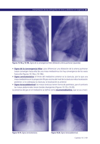 • Signo de la convergencia hiliar: para diferenciar una dilatación de la arteria pulmonar
(vasos convergen hacia ella) de una masa mediastínica (no hay convergencia de los vasos
hacia ella (figuras 10.18a y 10.18b).
• Signo cervicotorácico: el límite del mediastino anterior es la clavícula, por lo que una
masa mediastínica en la proyección PA por encima del nivel de la clavícula indica localización
posterior; si no sobrepasa la clavícula, la localización es anterior.
• Signo toracoabdominal: las masas torácicas tienen forma de paréntesis, por el contrario
las masas abdominales tienen bordes divergentes (Figuras 10.19 y 10.20).
La presencia de gas en el mediastino se define como neumomediastino, que se va a mani-
Interpretación de las radiografías de tórax y abdomen en Urgencias
Capítulo 10 l 121
Figuras 10.18a y 10.18b. Signo de la convergencia hiliar (dilatación arteria pulmonar izquierda).
Figura 10.19. Signo cervicotorácico. Figura 10.20. Signo toracoabdominal.
 