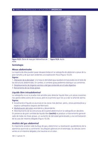 Semiología
Masas abdominales
La mayoría de ellas pueden pasar desapercibidas en la radiografía de abdomen a pesar de su
gran tamaño y de que sean evidentes a la exploración física (Figura 10.23).
Signos:
1. Alteración de la densidad: si la masa es densidad agua quedará enmascarada con el resto de
las estructuras abdominales. En cambio, si contiene grasa podremos distinguir sus contornos.
2. Desplazamiento de órganos vecinos o del gas contenido en el tubo digestivo.
3. Borramiento de las líneas grasas.
Líquido libre intraabdominal
La radiografía no es la prueba más sensible para detectar líquido libre y en pocas ocasiones
nos aporta datos acerca de la causa, pero es la primera que nos va a dar la señal de alarma.
Signos:
• Inicialmente el líquido se acumula en las zonas más declives: pelvis, zonas parietocólicas y
espacio subhepático (espacio de Morrison).
• Medialización del colon ascendente y descendente.
• Abombamiento de las estructuras de la pared abdominal en la radiografía en decúbito.
En presencia de gran cantidad de líquido libre (ascitis) se produce un borramiento generali-
zado de todas las líneas grasas, un aumento de densidad generalizado y una centralización
de las asas de intestino delgado (Figura 10.24).
Análisis del gas abdominal
Es importante analizar cada burbuja de gas y determinar su localización ayudándonos de la
apariencia que le da su continente: los pliegues gástricos en el estómago, las válvulas conni-
ventes en el intestino delgado y las haustras en el colon.
MANUAL DE PROTOCOLOS Y ACTUACIÓN EN URGENCIAS
124 l Capítulo 10
Figura 10.23. Efecto de masa por hidronefrosis de-
recha.
Figura 10.24. Ascitis.
 