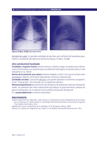 del balón de rugby” en grandes cantidades de aire libre, por insuflación de las gotieras para-
cólicas y visualización del ligamento falciforme (Figuras 10.28a y 10.28b).
Aire extraluminal localizado
Cavidades u órganos huecos como la vesícula, vía biliar o vejiga. Se produce por inflama-
ciones enfisematosas y se caracteriza por una distensión del órgano con presencia de un nivel
hidroaéreo en su interior.
Dentro de la pared de una víscera (intestino delgado y colon): es lo que se conoce como
neumatosis y aparece como líneas hiperlucentes, continuas o discontinuas.
Cavidades cerradas. Caso de los abscesos, que pueden presentar inicialmente una aparien-
cia en “miga de pan” (no confundir con un segmento colónico).
Retroneumoperitoneo por perforación del duodeno o de segmentos colónicos retroperito-
neales. Se caracteriza por líneas hiperlucentes que dibujan la grasa perirrenal y disecan los
planos interfasciales; no se moviliza con los cambios de posición del paciente.
En la pared abdominal o enfisema subcutáneo.
BIBLIOGRAFÍA
Aguilar Angulo PM, Ruiz-Yagüe MC, Julián Jiménez A. Interpretación de las radiografías de tórax y abdo-
men en urgencias. En: Julián Jiménez A. Coordinador. Manual de protocolos y actuaciones en urgencias
3ª ed. Madrid: Nilo Gráfica; 2010.
Novelline RA. Squire. Fundamentos de la radiología. 5ª ed. Barcelona: Masson; 2000.
Pedrosa CS, Casanova R. Diagnóstico por imagen. 2ª ed. Madrid: McGrawHill-Interamericana; 1997.
MANUAL DE PROTOCOLOS Y ACTUACIÓN EN URGENCIAS
126 l Capítulo 10
Figuras 10.28a y 10.28b. Neumoperitoneo.
 