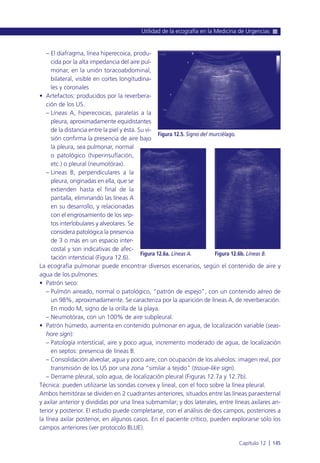 – El diafragma, línea hiperecoica, produ-
cida por la alta impedancia del aire pul-
monar, en la unión toracoabdominal,
bilateral, visible en cortes longitudina-
les y coronales
• Artefactos: producidos por la reverbera-
ción de los US.
– Líneas A, hiperecoicas, paralelas a la
pleura, aproximadamente equidistantes
de la distancia entre la piel y ésta. Su vi-
sión confirma la presencia de aire bajo
la pleura, sea pulmonar, normal
o patológico (hiperinsuflación,
etc.) o pleural (neumotórax).
– Líneas B, perpendiculares a la
pleura, originadas en ella, que se
extienden hasta el final de la
pantalla, eliminando las líneas A
en su desarrollo, y relacionadas
con el engrosamiento de los sep-
tos interlobulares y alveolares. Se
considera patológica la presencia
de 3 o más en un espacio inter-
costal y son indicativas de afec-
tación intersticial (Figura 12.6).
La ecografía pulmonar puede encontrar diversos escenarios, según el contenido de aire y
agua de los pulmones:
• Patrón seco:
– Pulmón aireado, normal o patológico, “patrón de espejo”, con un contenido aéreo de
un 98%, aproximadamente. Se caracteriza por la aparición de líneas A, de reverberación.
En modo M, signo de la orilla de la playa.
– Neumotórax, con un 100% de aire subpleural.
• Patrón húmedo, aumenta en contenido pulmonar en agua, de localización variable (seas-
hore sign):
– Patología intersticial, aire y poco agua, incremento moderado de agua, de localización
en septos: presencia de líneas B.
– Consolidación alveolar, agua y poco aire, con ocupación de los alvéolos: imagen real, por
transmisión de los US por una zona “similar a tejido” (tissue-like sign).
– Derrame pleural, solo agua, de localización pleural (Figuras 12.7a y 12.7b).
Técnica: pueden utilizarse las sondas convex y lineal, con el foco sobre la línea pleural.
Ambos hemitórax se dividen en 2 cuadrantes anteriores, situados entre las líneas paraesternal
y axilar anterior y divididas por una línea submamilar; y dos laterales, entre líneas axilares an-
terior y posterior. El estudio puede completarse, con el análisis de dos campos, posteriores a
la línea axilar posterior, en algunos casos. En el paciente crítico, pueden explorarse sólo los
campos anteriores (ver protocolo BLUE).
Utilidad de la ecografía en la Medicina de Urgencias
Capítulo 12 l 145
Figura 12.5. Signo del murciélago.
Figura 12.6a. Líneas A. Figura 12.6b. Líneas B.
 