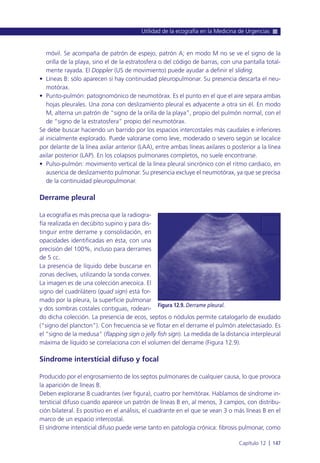 móvil. Se acompaña de patrón de espejo, patrón A; en modo M no se ve el signo de la
orilla de la playa, sino el de la estratosfera o del código de barras, con una pantalla total-
mente rayada. El Doppler (US de movimiento) puede ayudar a definir el sliding.
• Líneas B: sólo aparecen si hay continuidad pleuropulmonar. Su presencia descarta el neu-
motórax.
• Punto-pulmón: patognomónico de neumotórax. Es el punto en el que el aire separa ambas
hojas pleurales. Una zona con deslizamiento pleural es adyacente a otra sin él. En modo
M, alterna un patrón de “signo de la orilla de la playa”, propio del pulmón normal, con el
de “signo de la estratosfera” propio del neumotórax.
Se debe buscar haciendo un barrido por los espacios intercostales más caudales e inferiores
al inicialmente explorado. Puede valorarse como leve, moderado o severo según se localice
por delante de la línea axilar anterior (LAA), entre ambas líneas axilares o posterior a la línea
axilar posterior (LAP). En los colapsos pulmonares completos, no suele encontrarse.
• Pulso-pulmón: movimiento vertical de la línea pleural sincrónico con el ritmo cardiaco, en
ausencia de deslizamiento pulmonar. Su presencia excluye el neumotórax, ya que se precisa
de la continuidad pleuropulmonar.
Derrame pleural
La ecografía es más precisa que la radiogra-
fía realizada en decúbito supino y para dis-
tinguir entre derrame y consolidación, en
opacidades identificadas en ésta, con una
precisión del 100%, incluso para derrames
de 5 cc.
La presencia de líquido debe buscarse en
zonas declives, utilizando la sonda convex.
La imagen es de una colección anecoica. El
signo del cuadrilátero (quad sign) está for-
mado por la pleura, la superficie pulmonar
y dos sombras costales contiguas, rodean-
do dicha colección. La presencia de ecos, septos o nódulos permite catalogarlo de exudado
(“signo del plancton”). Con frecuencia se ve flotar en el derrame el pulmón atelectasiado. Es
el “signo de la medusa” (flapping sign o jelly fish sign). La medida de la distancia interpleural
máxima de líquido se correlaciona con el volumen del derrame (Figura 12.9).
Síndrome intersticial difuso y focal
Producido por el engrosamiento de los septos pulmonares de cualquier causa, lo que provoca
la aparición de líneas B.
Deben explorarse 8 cuadrantes (ver figura), cuatro por hemitórax. Hablamos de síndrome in-
tersticial difuso cuando aparece un patrón de líneas B en, al menos, 3 campos, con distribu-
ción bilateral. Es positivo en el análisis, el cuadrante en el que se vean 3 o más líneas B en el
marco de un espacio intercostal.
El síndrome intersticial difuso puede verse tanto en patología crónica: fibrosis pulmonar, como
Utilidad de la ecografía en la Medicina de Urgencias
Capítulo 12 l 147
Figura 12.9. Derrame pleural.
 