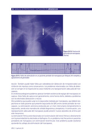 tección. También puede haber fallos por sobredetección (detección de minipotenciales) con
inhibición de impulsos como consecuencia. Los problemas relacionados con fallos de detec-
ción se corrigen en la mayoría de los casos mediante una reprogramación adecuada del mar-
capasos.
En el electrocardiograma podemos apreciar también existencia de espigas del marcapasos sin
captura. Estos fallos de captura son generalmente, como hemos dicho, debidos a problemas
con los electrodos (dislocación o rotura).
Otro problema que puede surgir es la taquicardia mediada por marcapasos, que deberá sos-
pecharse en todo paciente que presente taquicardia de QRS ancho siendo portador de mar-
capasos. La estimulación asíncrona producida por un imán interrumpiría temporalmente la
taquicardia, siendo esta maniobra de utilidad diagnóstica y terapéutica. A continuación, una
reprogramación adecuada del marcapasos puede prevenir nuevos episodios de arritmia por
este mecanismo.
La estimulación frénica está relacionada con la estimulación del nervio frénico o directamente
con la proximidad de los electrodos al diafragma. Es un problema más frecuente en pacientes
portadores de marcapasos con estimulación biventricular. Este problema puede resolverse
ajustando los voltajes de estimulación del marcapasos.
MANUAL DE PROTOCOLOS Y ACTUACIÓN EN URGENCIAS
278 l Capítulo 24
Figura 24.14. Fractura de
electrodo de marcapasos
(flecha).
Figura 24.15. Fallos de estimulación en un paciente portador de marcapasos por bloqueo AV completo y
agotamiento de generador.
 