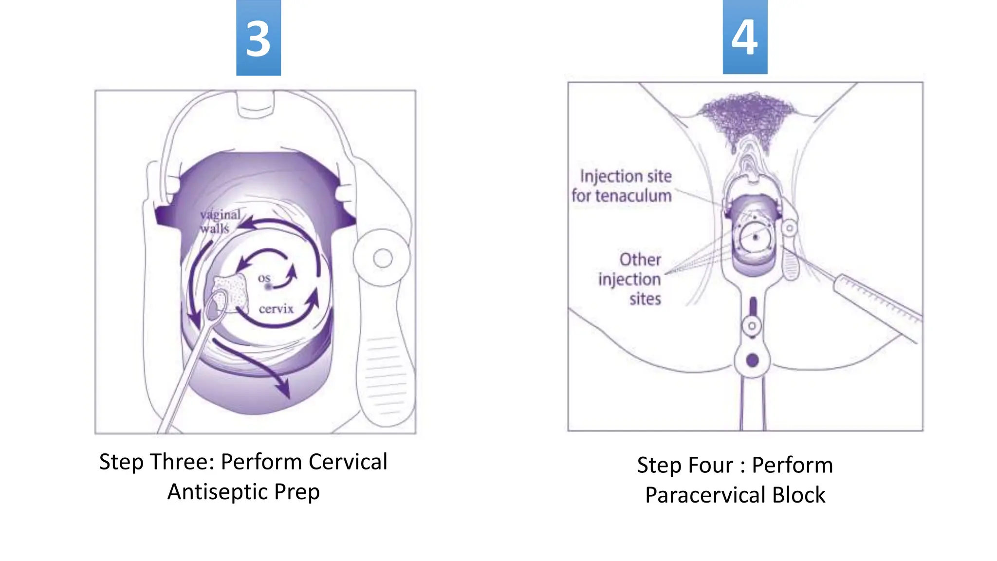 Step Three: Perform Cervical
Antiseptic Prep
Step Four : Perform
Paracervical Block
 