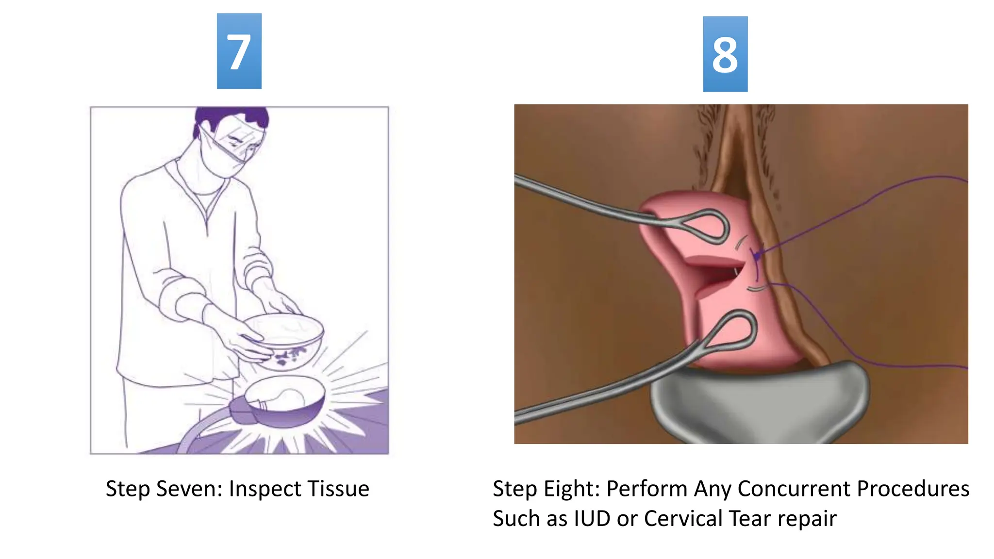 Step Seven: Inspect Tissue Step Eight: Perform Any Concurrent Procedures
Such as IUD or Cervical Tear repair
 