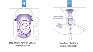 Paracervical Injection Manual Vaccum Aspiration- A step by step guide. | PPTX