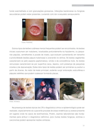 77
LEISHMANIOSES
fundo avermelhado e com granulações grosseiras. Infecções bacterianas ou fúngicas
secundárias podem estar presentes, cursando com dor e exsudato seropurulento.
	 Fotos: FIOCRUZ
Outros tipos de lesões cutâneas menos frequentes podem ser encontrados. As lesões
iniciais costumam ser nodulares, localizadas profundamente na hipoderme, ou peque-
nas pápulas, semelhantes à picada de inseto, que evoluem aumentando em tamanho
e profundidade (lesões pápulo-tuberosas) e ulcerando no vértice. As lesões vegetantes
caracterizam-se pelo aspecto papilomatoso, úmido e de consistência mole. As lesões
verrucosas caracterizam-se por superfície seca, áspera, com presença de pequenas
crostas e de descamação. Estes dois tipos de lesões podem ser primárias ou evoluir a
partir de úlceras. Ao redor da lesão principal, poderão surgir enduração subcutânea e
pápulas satélites que podem coalescer formando placas.
Fotos: A Franco
Na presença de lesões típicas de LTA o diagnóstico clínico e epidemiológico pode ser
realizado, especialmente se o paciente procede de áreas endêmicas ou esteve presente
em lugares onde há casos de leishmaniose. Porém, exames laboratoriais são funda-
mentais para atribuir o diagnóstico definitivo, pois muitas lesões fúngicas, ectimas e
carcinomas podem apresentar lesões similares.
 