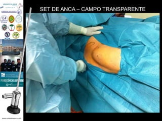 www.unidadedaanca.com
SET DE ANCA – CAMPO TRANSPARENTE
 