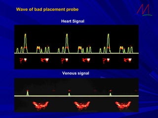 Wave of bad placement probe Heart Signal Venous signal 