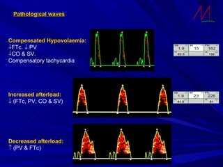 Pathological waves Decreased afterload:    (PV & FTc) Compensated Hypovolaemia: FTc.    PV CO & SV. Compensatory tachycardia Increased afterload:    (FTc, PV, CO & SV) 