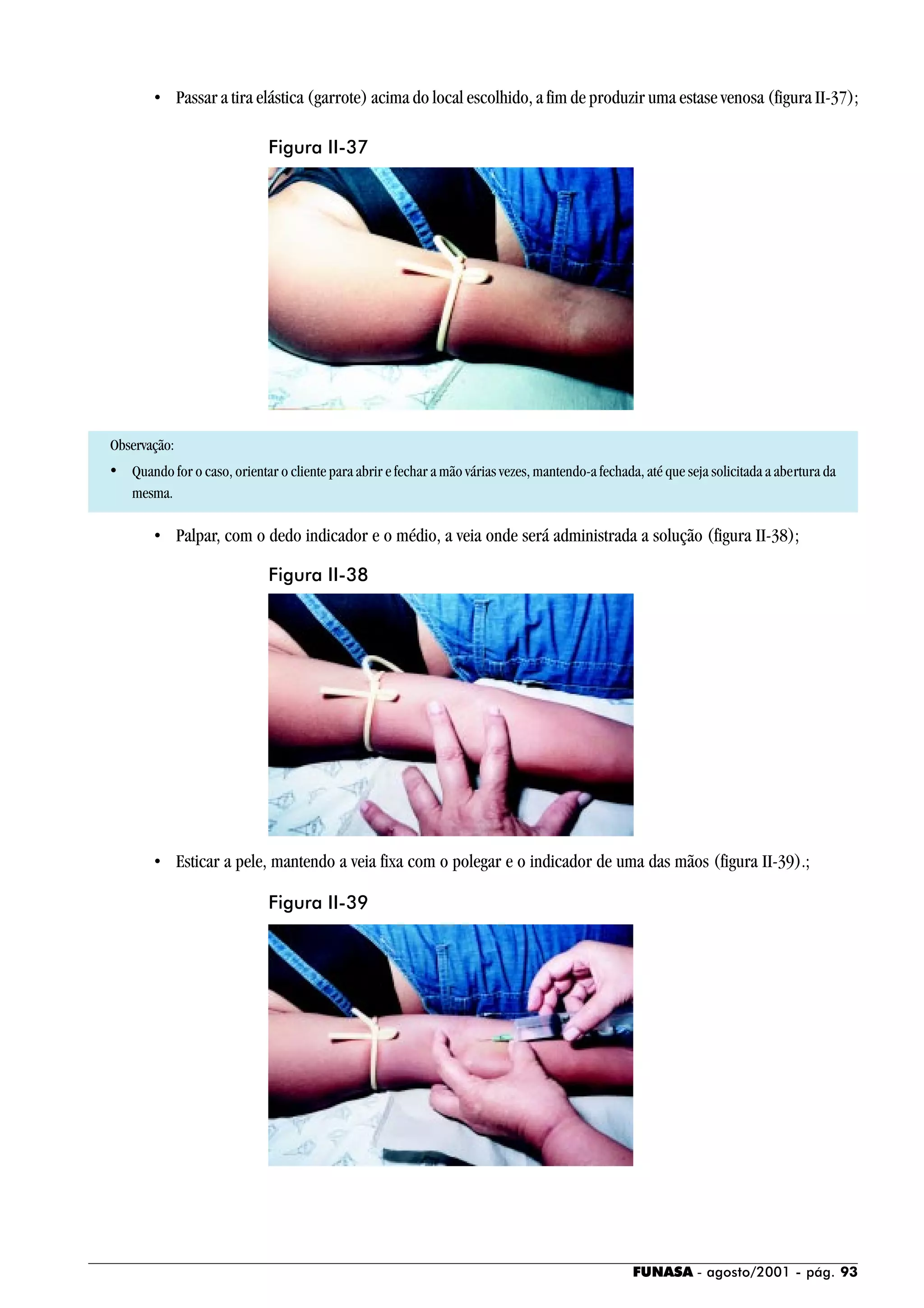 FUNASA - agosto/2001 - pág. 93
• Passar a tira elástica (garrote) acima do local escolhido, a fim de produzir uma estase venosa (figura II-37);
Observação:
• Quando for o caso, orientar o cliente para abrir e fechar a mão várias vezes, mantendo-a fechada, até que seja solicitada a abertura da
mesma.
• Palpar, com o dedo indicador e o médio, a veia onde será administrada a solução (figura II-38);
• Esticar a pele, mantendo a veia fixa com o polegar e o indicador de uma das mãos (figura II-39).;
Figura II-37
Figura II-38
Figura II-39
 