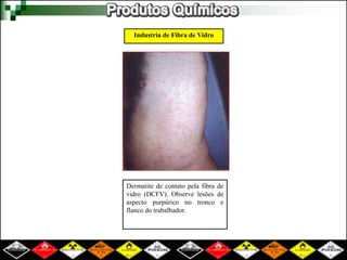 Industria de Fibra de Vidro
Dermatite de contato pela fibra de
vidro (DCFV). Observe lesões de
aspecto purpúrico no tronco e
flanco do trabalhador.
 