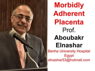 Morbidly
Adherent
Placenta
Prof.
Aboubakr
Elnashar
Benha University Hospital
Egypt
elnashar53@hotmail.com
 