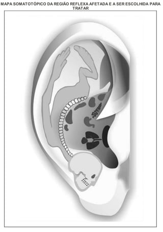 MAPA SOMATOTÓPICO DA REGIÃO REFLEXA AFETADA E A SER ESCOLHIDA PARA
TRATAR
 
