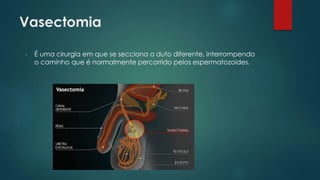 Vasectomia
- É uma cirurgia em que se secciona o duto diferente, interrompendo
o caminho que é normalmente percorrido pelos espermatozoides.
 