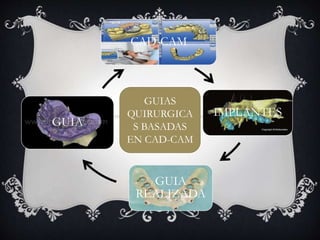 CAD-CAM
IMPLANTES
GUIA
REALIZADA
GUIA
GUIAS
QUIRURGICA
S BASADAS
EN CAD-CAM
 