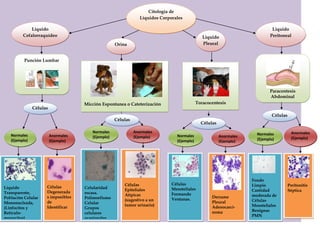 Citología de
Líquidos Corporales
Liquido
Cefalorraquídeo
Orina
Liquido
Pleural
Liquido
Peritoneal
Punción Lumbar
Células
Normales
(Ejemplo)
Anormales
(Ejemplo)
Líquido
Transparente,
Población Celular
Mononucleada,
(Linfocitos y
Retículo-
monocitos)
Derrame
Pleural
Adenocarci-
noma
Peritonitis
Séptica
Células
Degenerada
s imposibles
de
Identificar
Micción Espontanea o Cateterización
Celularidad
escasa.
Polimorfismo
Celular
Grupos
celulares
ocasionales.
Fondo limpio.
Células
Epiteliales
Atípicas
(sugestivo a un
tumor urinario)
Células
Normales
(Ejemplo)
Anormales
(Ejemplo)
Toracocentesis
Paracentesis
Abdominal
Células
Células
Normales
(Ejemplo)
Normales
(Ejemplo)
Anormales
(Ejemplo)
Anormales
(Ejemplo)
Fondo
Limpio
Cantidad
moderada de
Células
Mesoteliales
Benignas
PMN
Células
Mesoteliales
Formando
Ventanas.
 