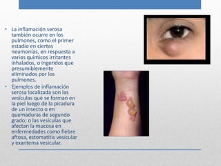 • La inflamación serosa 
también ocurre en los 
pulmones, como el primer 
estadío en ciertas 
neumonías, en respuesta a 
varios químicos irritantes 
inhalados, o ingeridos que 
presumiblemente 
eliminados por los 
pulmones. 
• Ejemplos de inflamación 
serosa localizada son las 
vesículas que se forman en 
la piel luego de la picadura 
de un insecto o en 
quemaduras de segundo 
grado; o las vesículas que 
afectan la mucosa en 
enfermedades como fiebre 
aftosa, estomatitis vesicular 
y exantema vesicular. 
 