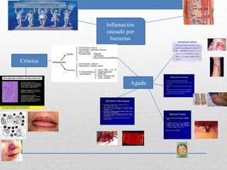 Inflamación 
causado por 
bacterias 
Aguda 
Crónica 
 