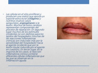 • Las células en el sitio proliferan y 
producen una matriz que aporta un 
soporte estructural (colágeno) y 
nutritivo (nuevos vasos 
sanguíneos, angiogénesis) a la 
lesión. Muchos de estos cambios 
representan componentes del 
proceso de reparación. En segundo 
lugar muchos de los estímulos 
incidentes no son dañinos para los 
tejidos del hospedador (muchas de 
las reacciones inflamatorias 
crónicas son inducidas más por la 
sensibilidad del hospedador hacia 
el agente incidente que por la 
lesión tisular inducida por el agente 
en cuestión). En tercer lugar, en la 
mayoría de los casos, la reacción 
inflamatoria crónica contiene 
diferentes células inflamatorias que 
las que se observan en la 
inflamación aguda. 
 