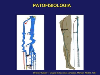 Stritecky-Kähler T. Cirugía de las venas varicosas. Marban, Madrid, 1997
PATOFISIOLOGIA
 