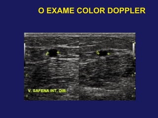 O EXAME COLOR DOPPLER
 