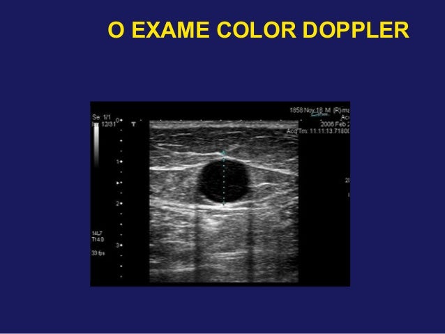 Exame doppler venoso