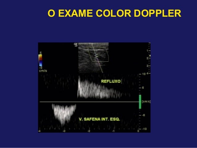 Exame doppler venoso