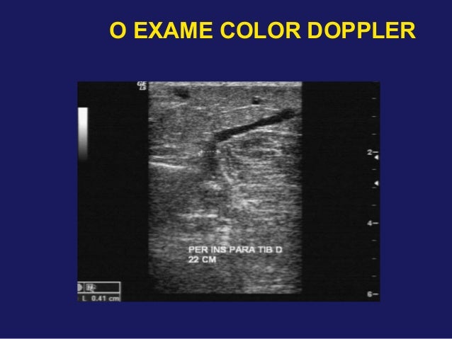 Exame doppler venoso