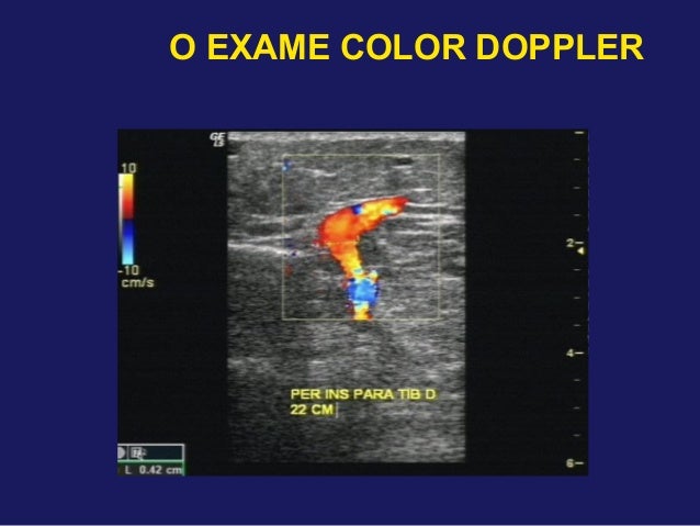 Exame doppler venoso