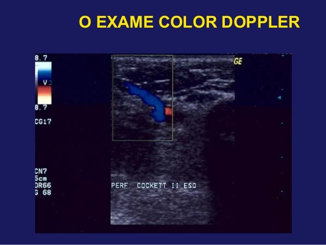 Exame doppler venoso