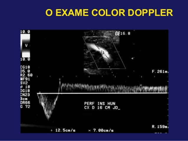 Exame doppler venoso