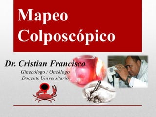 Mapeo
Colposcópico
 