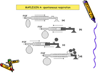 MAPLESON A- spontaneous respiration 