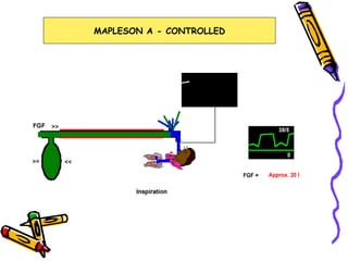 MAPLESON A - CONTROLLED 