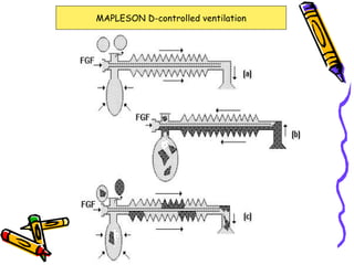 MAPLESON D-controlled ventilation 